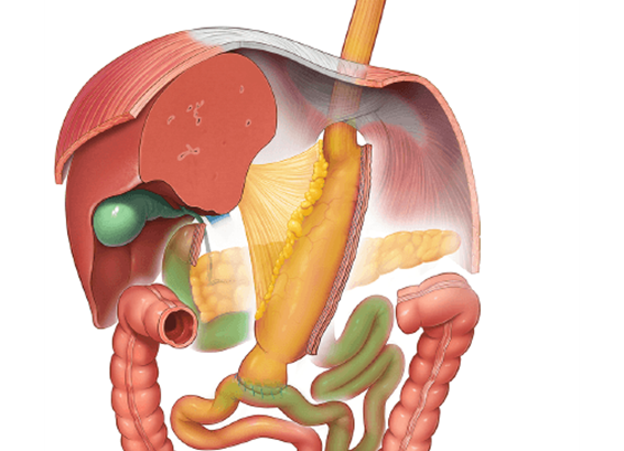 One Anastomosis Gastric Bypass Ifso Ec 9575